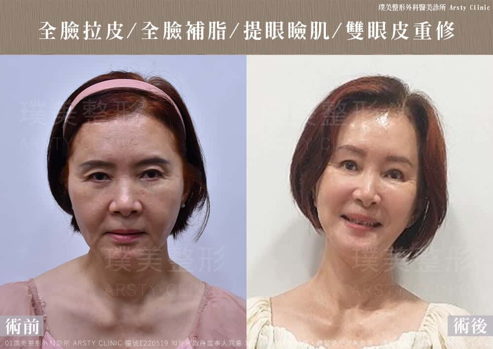 全臉拉皮手術推薦案例分享