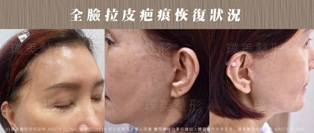 全臉拉皮手術推薦案例分享