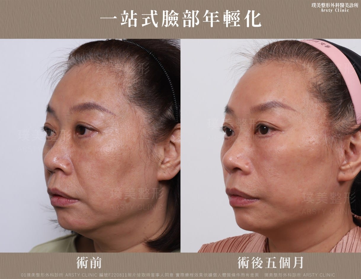 全臉拉皮手術推薦案例分享