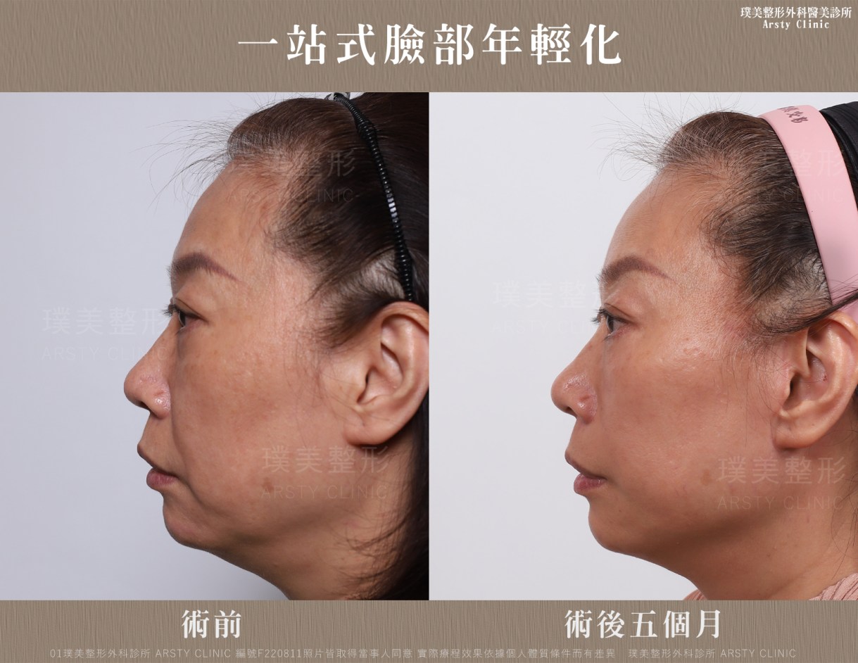 全臉拉皮手術推薦案例分享