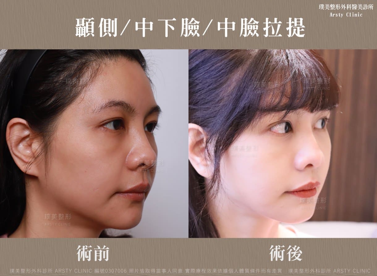 全臉拉皮手術推薦案例分享