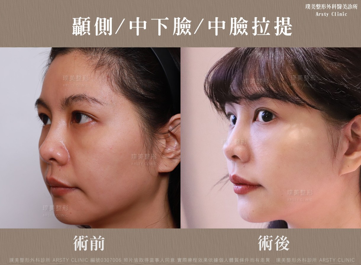 全臉拉皮手術推薦案例分享