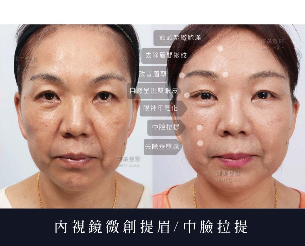 全臉拉皮手術推薦案例分享
