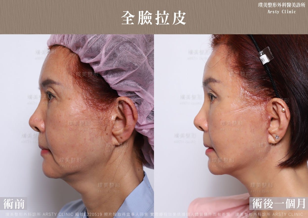 全臉拉皮手術推薦案例分享