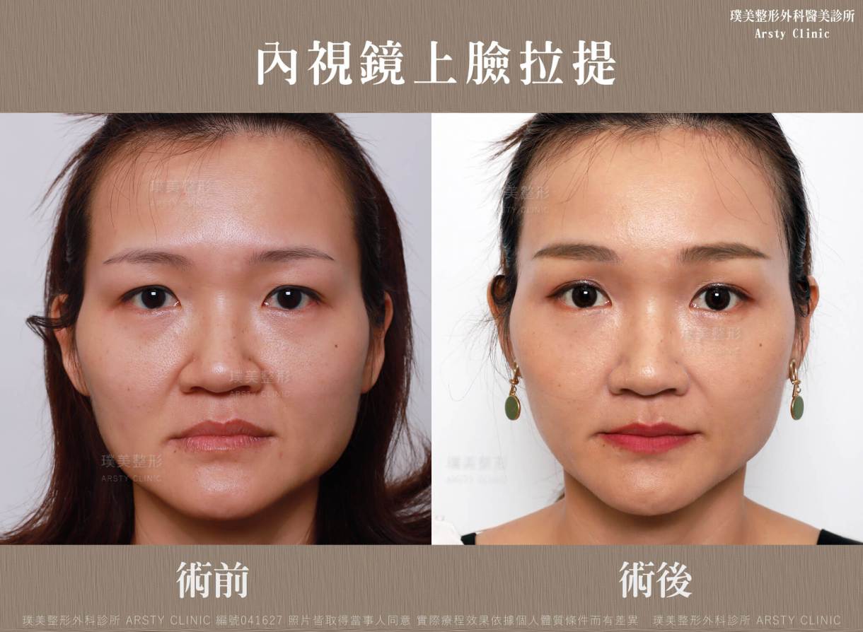 全臉拉皮手術推薦案例分享