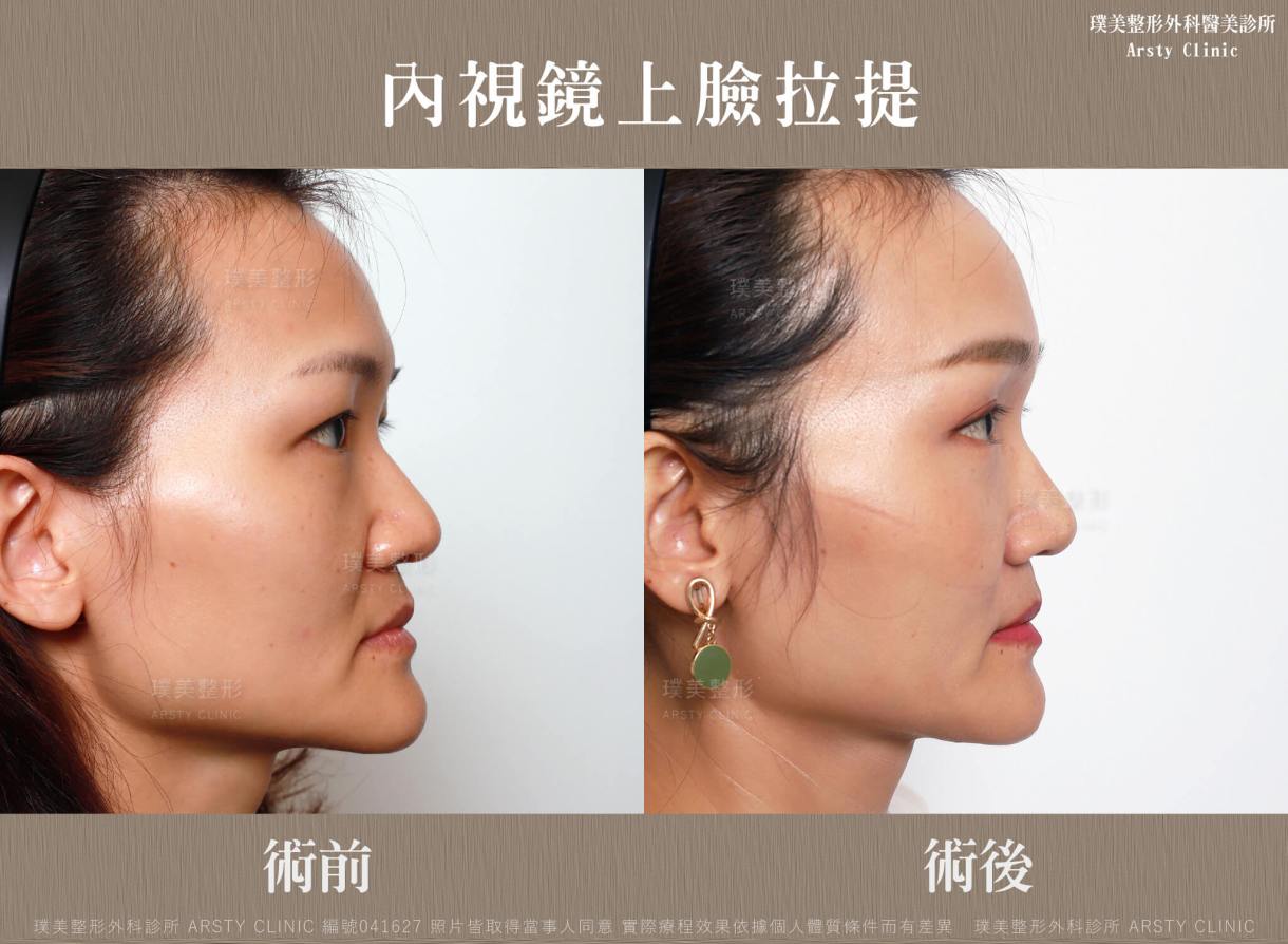全臉拉皮手術推薦案例分享