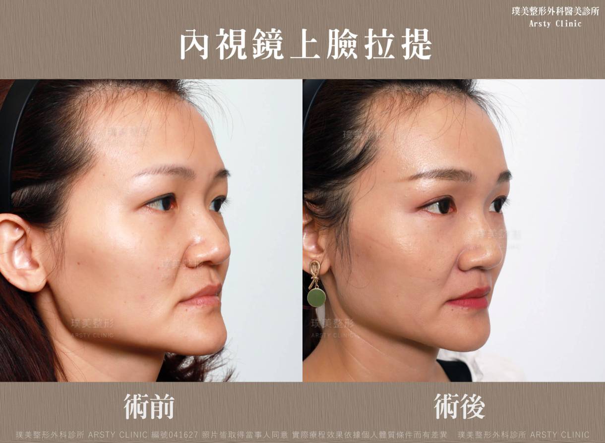 全臉拉皮手術推薦案例分享