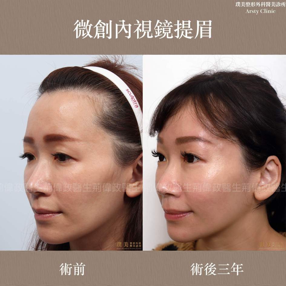 全臉拉皮手術推薦案例分享