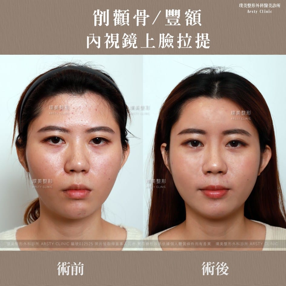 全臉拉皮手術推薦案例分享