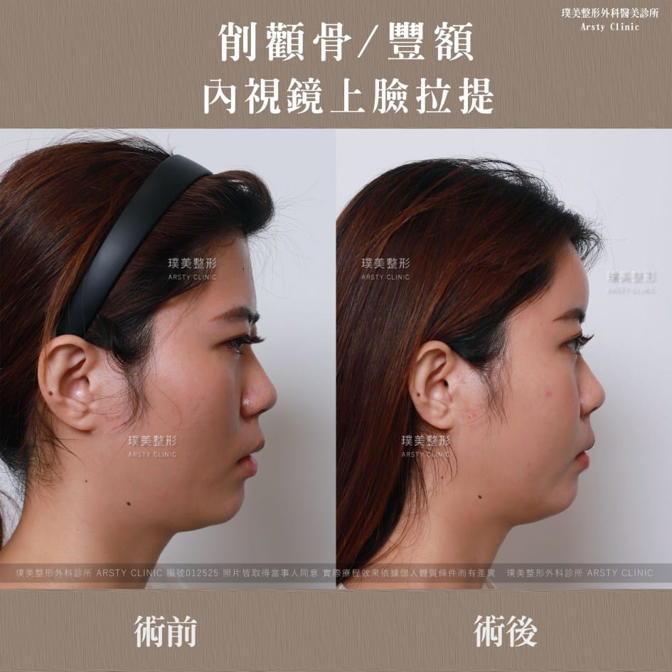全臉拉皮手術推薦案例分享