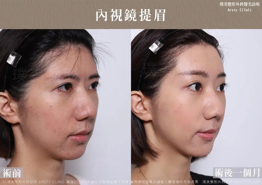 全臉拉皮手術推薦案例分享