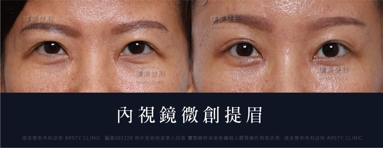 全臉拉皮手術推薦案例分享