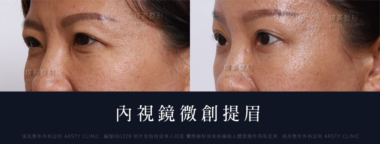 全臉拉皮手術推薦案例分享
