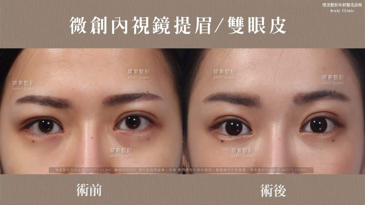 全臉拉皮手術推薦案例分享