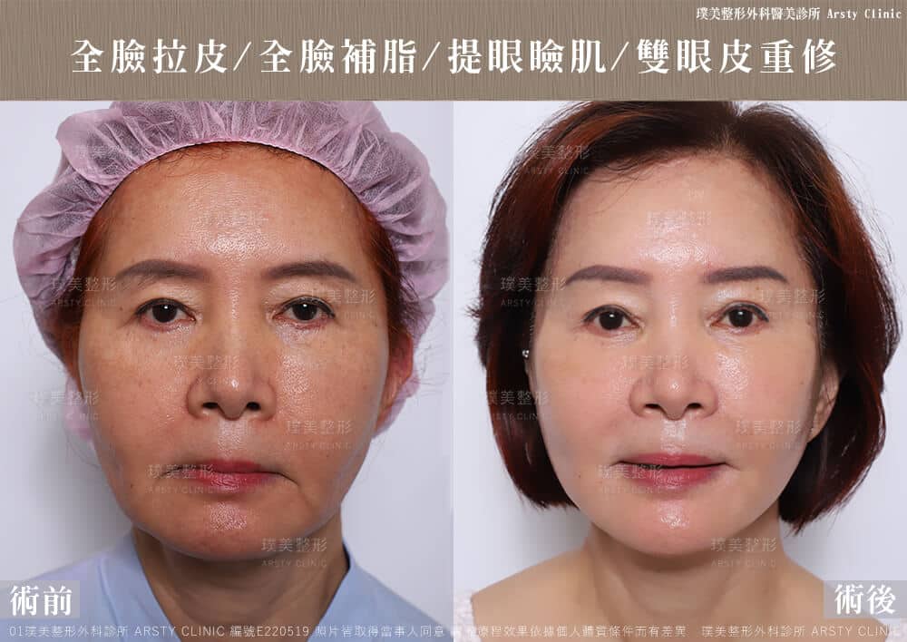 全臉拉皮手術推薦案例分享