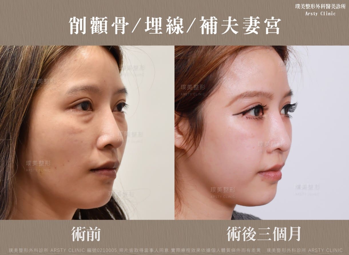 顎縮小術＋フェイスリフトの推奨症例