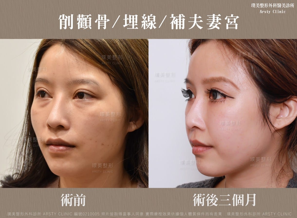 顎縮小術＋フェイスリフトの推奨症例