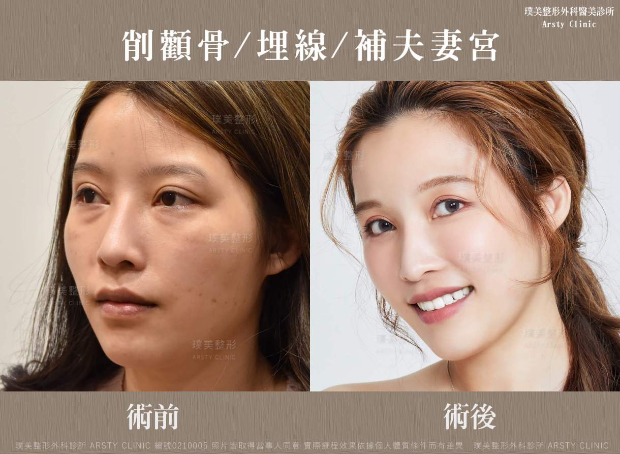 顎縮小術＋フェイスリフトの推奨症例