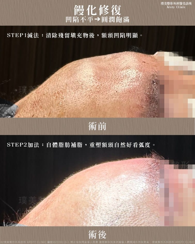 顔面形成手術によって生じた顔面の非対称性に対して、どのような対策が取れるのでしょうか？