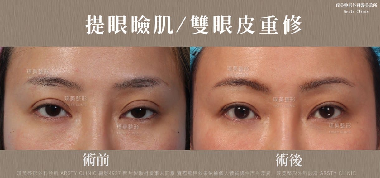 ▼黑眼珠露出部份少，眼神較渙散無光采▼