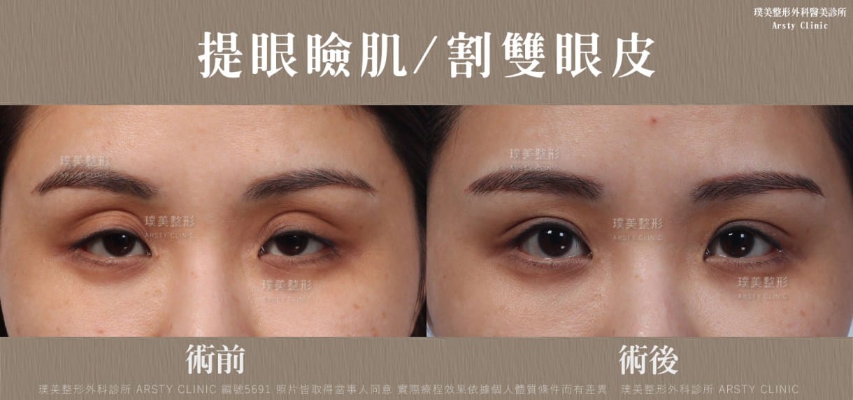 ▼雙眼皮過寬的無神感，提眼肌手術重塑明亮眼神▼