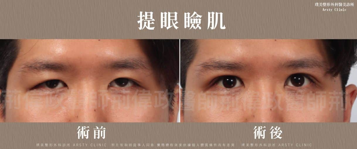 ▼眼皮較厚合併提眼瞼肌無力▼