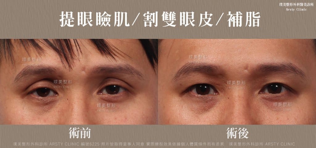 ▼術前提眼瞼肌無力，兩眼疲倦無神▼