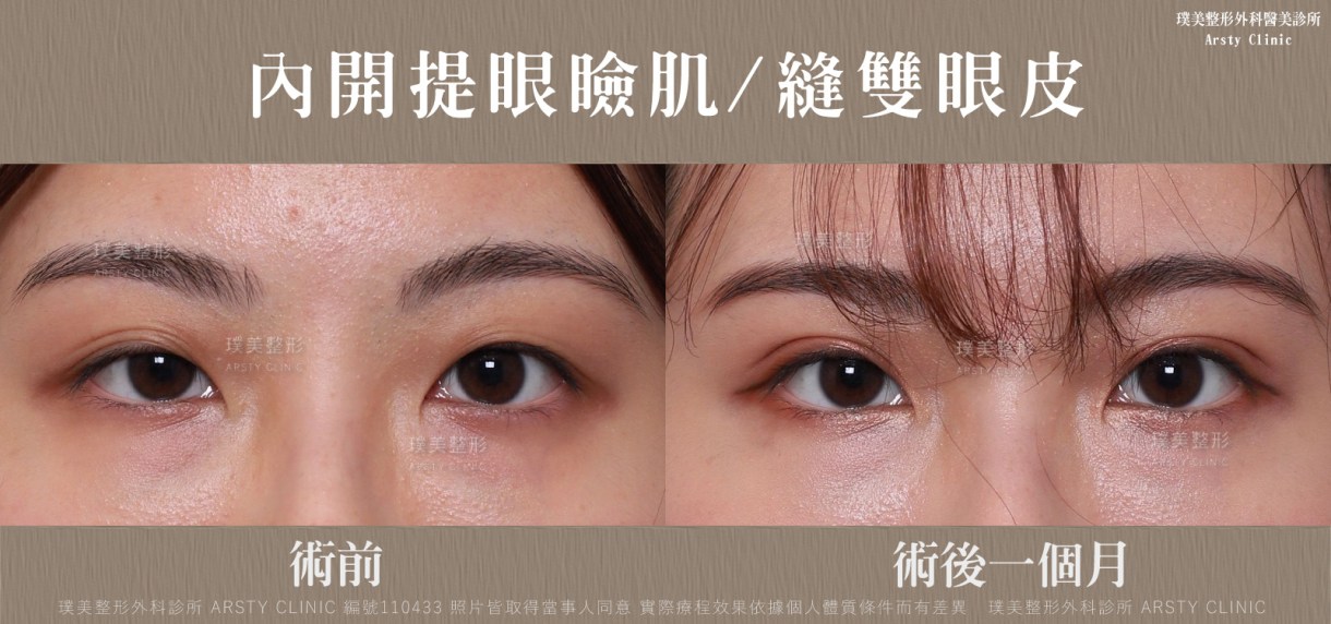▼提眼瞼肌手術矯正，術後可見不同▼