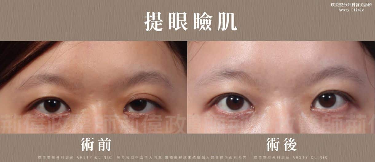 ▼單側提眼肌無力大小眼，透過提眼瞼肌手術→雙眼對稱有神▼