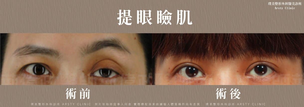 ▼左眼眼瞼肌無力，造成嚴重左右側眼睛不對側▼
