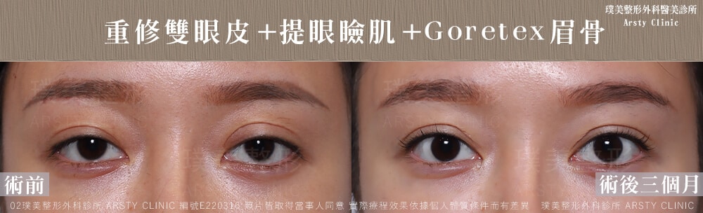 ▼複合式雙眼皮重修+提眼肌手術後，雙眼較有神▼