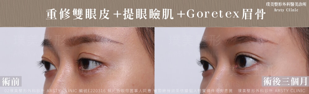 ▼複合式雙眼皮重修+提眼肌手術後，雙眼較有神▼