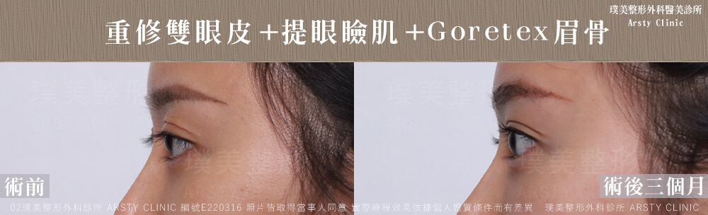 ▼複合式雙眼皮重修+提眼肌手術後，雙眼較有神▼