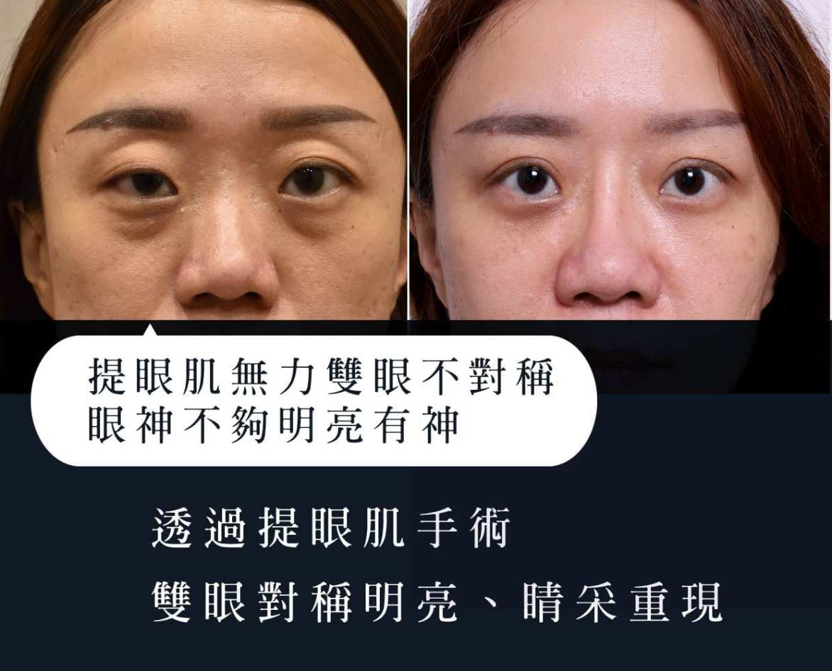 ▼複合式雙眼皮重修+提眼肌手術後，雙眼較有神▼
