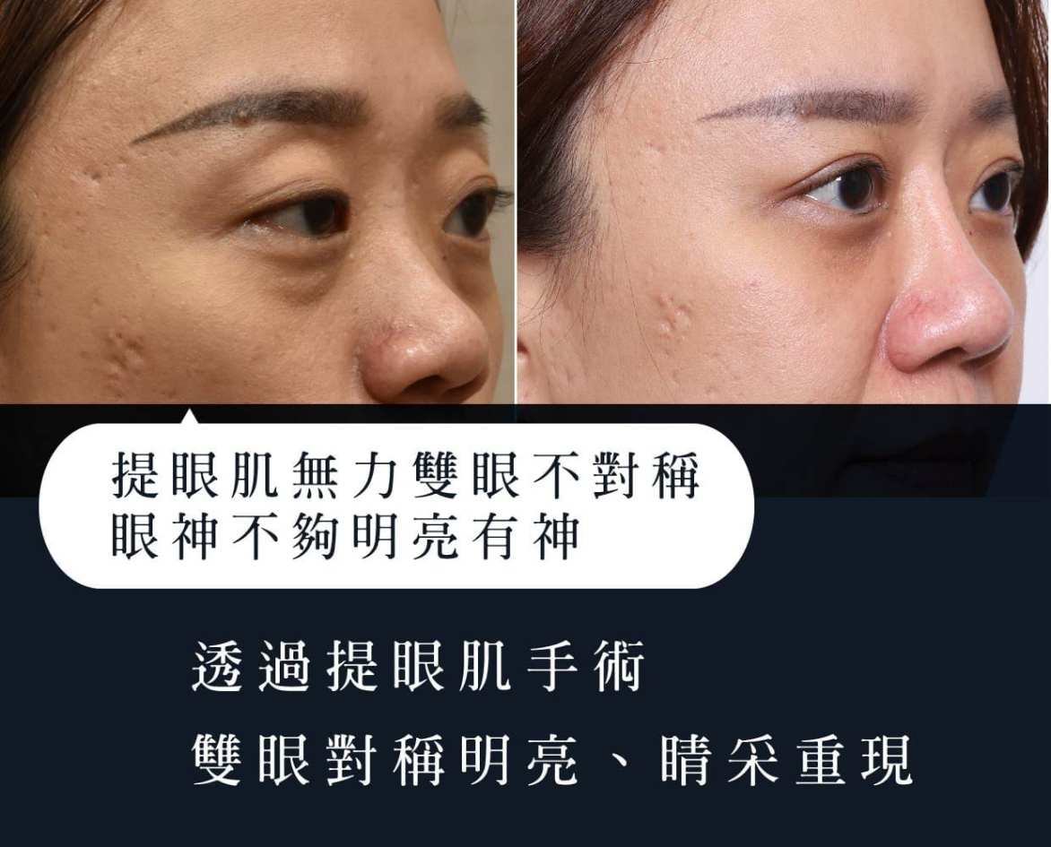 ▼複合式雙眼皮重修+提眼肌手術後，雙眼較有神▼