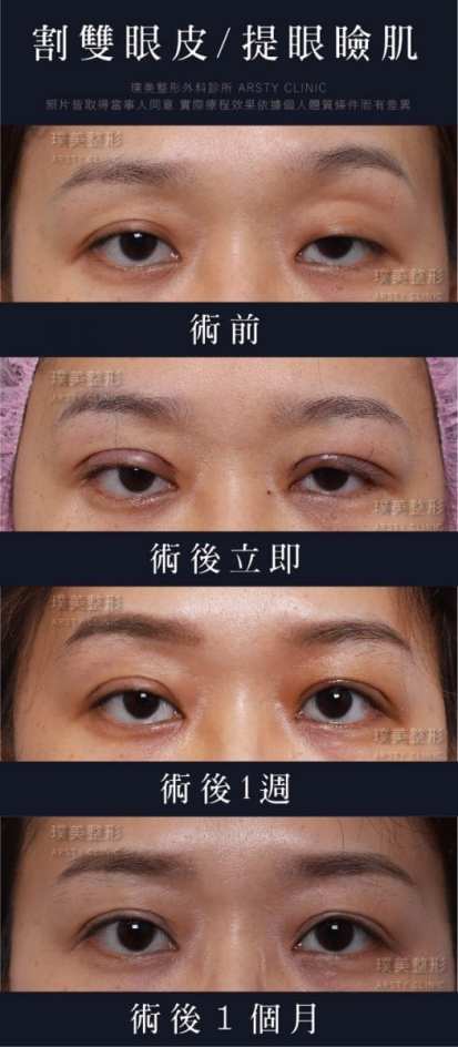 ▼複合式雙眼皮重修+提眼肌手術後，雙眼較有神▼