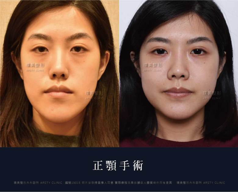 正顎手術推薦案例分享