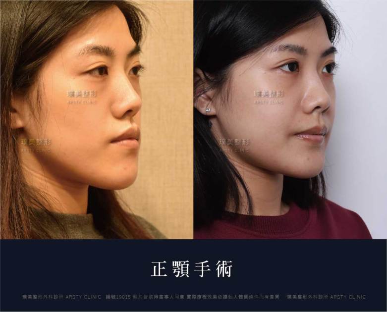 正顎手術推薦案例分享