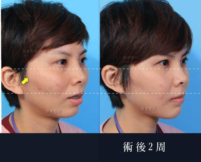 正顎手術推薦案例分享