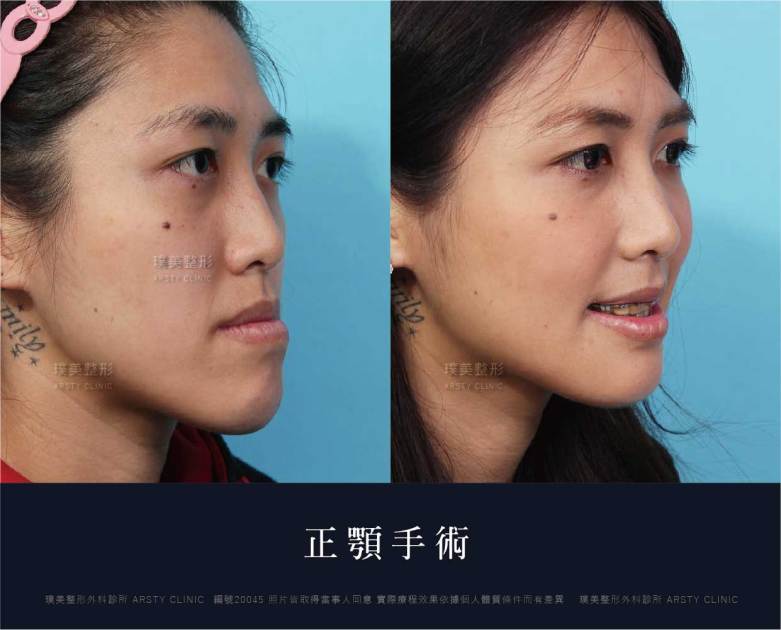 正顎手術推薦案例分享