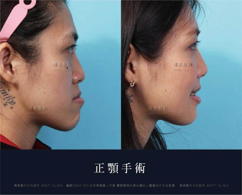 正顎手術推薦案例分享