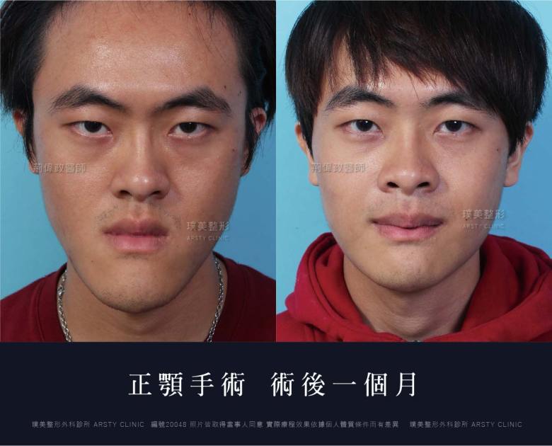 正顎手術推薦案例分享