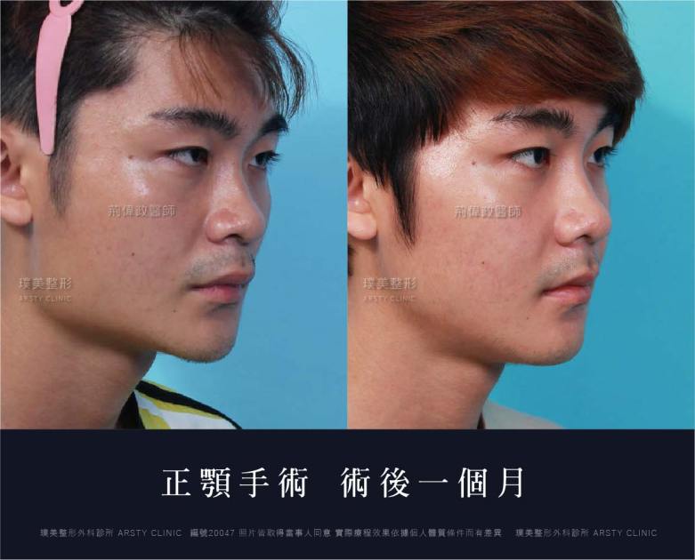 正顎手術推薦案例分享
