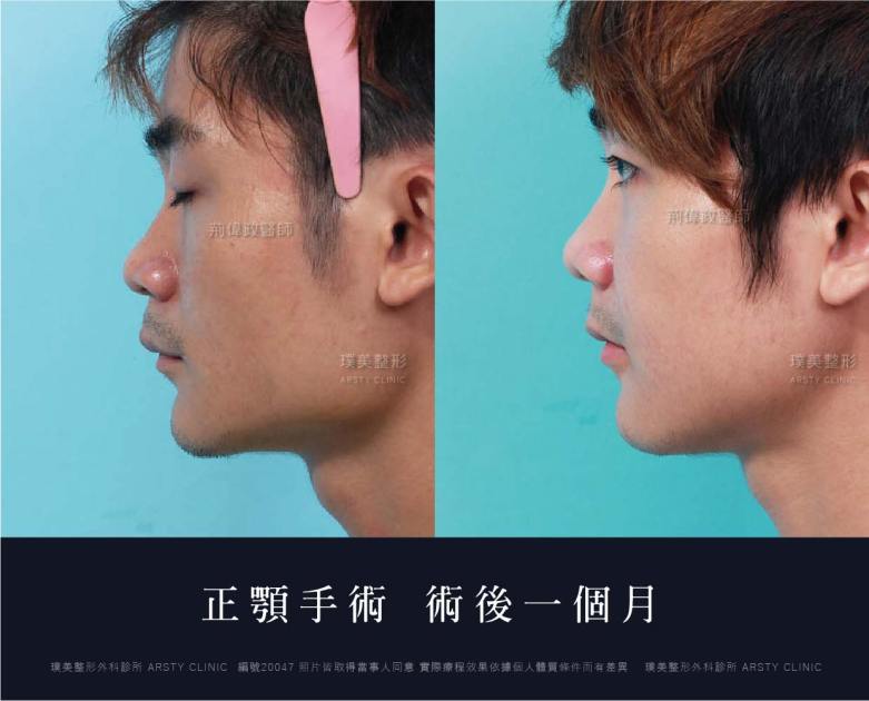 正顎手術推薦案例分享