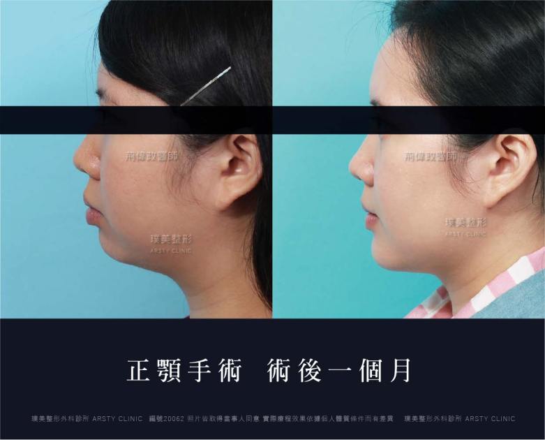 正顎手術推薦案例分享