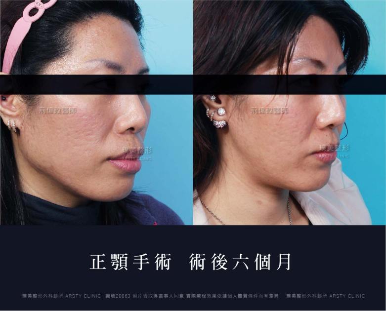 正顎手術推薦案例分享