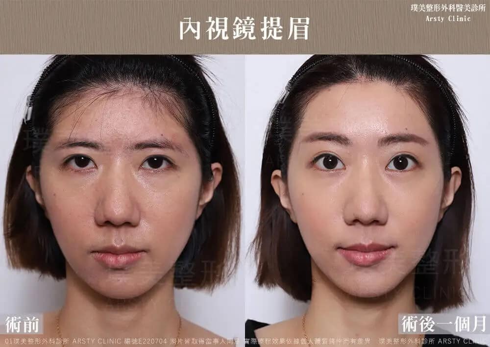 全臉拉皮手術推薦案例分享