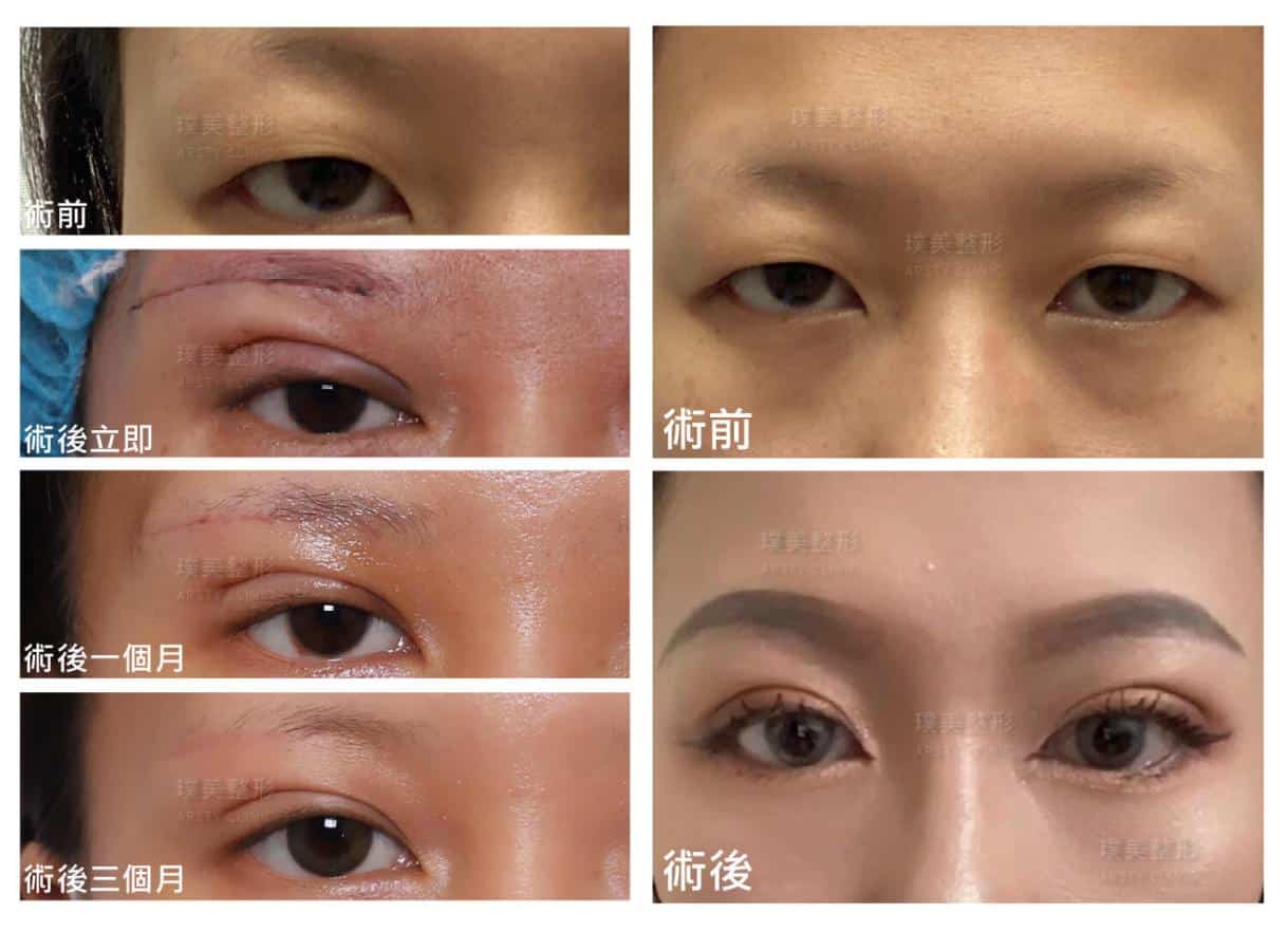 眉毛切開