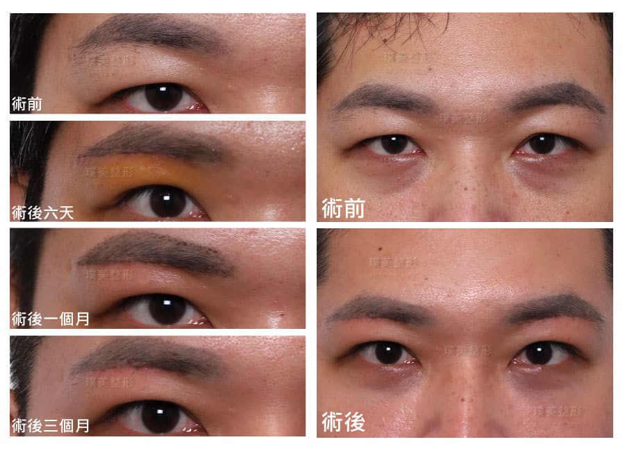 眉毛切開