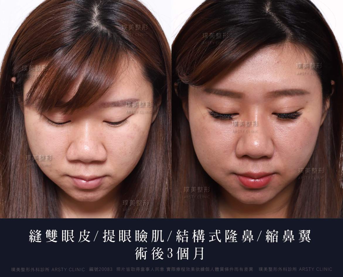隆鼻手術案例推薦